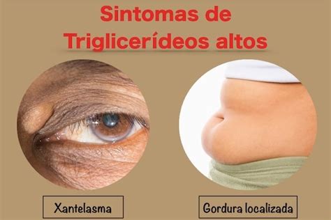 quais os sintomas de triglicerídeos alto